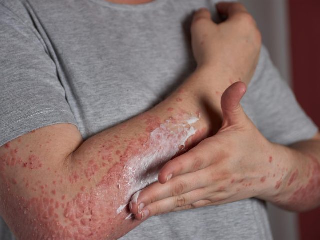 Skin Allergy Treatment in Siddha and Ayurveda – Natural Relief for Healthy Skin