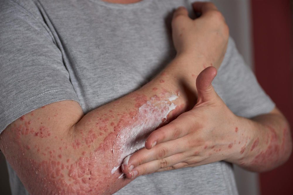 Skin Allergy Treatment in Nanded